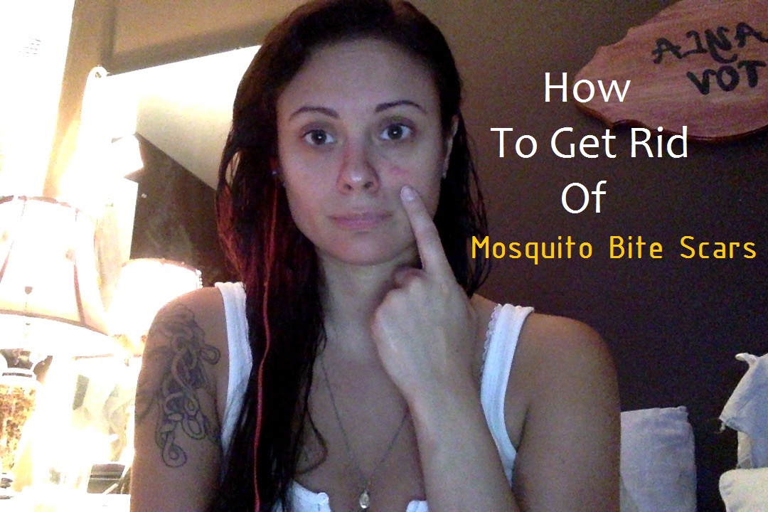 How to get rid of mosquito bite scars